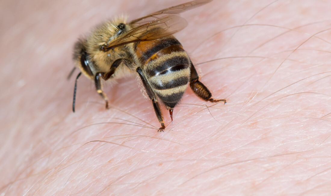 Arı sokmasına bağlı alerjik